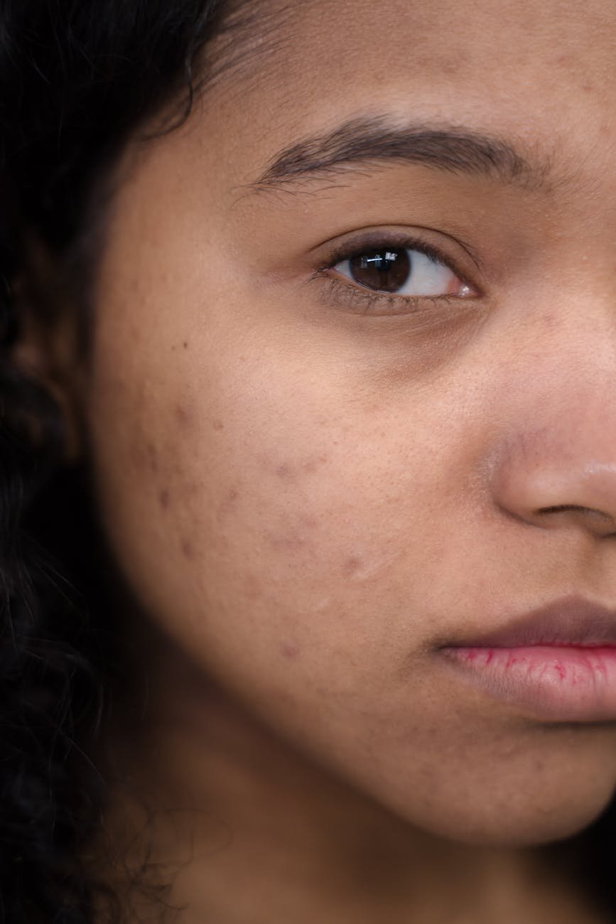 best chemical peels for fading acne scars